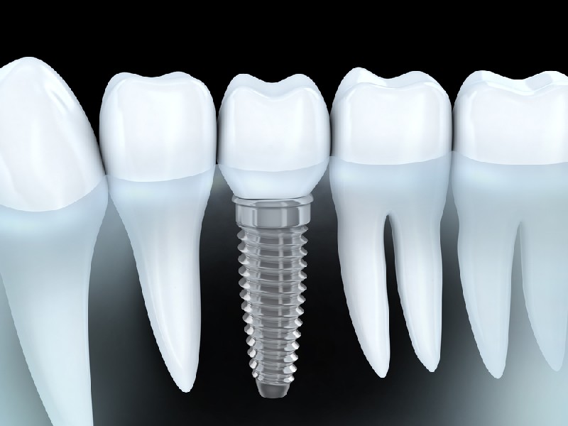Tooth-Implant-Mesa-AZ